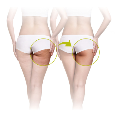 Masażer do cellulitu Lanaform Skin Mass 2