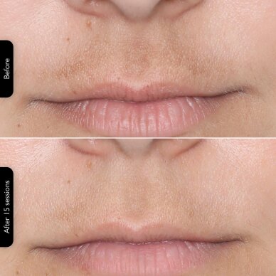 Facial rejuvenating LED mask Silk'n Face Mask 100 10 Facial rejuvenating LED mask Silk'n Face Mask 100 10