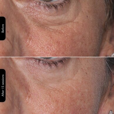 Facial rejuvenating LED mask Silk'n Face Mask 100 8 Facial rejuvenating LED mask Silk'n Face Mask 100 8