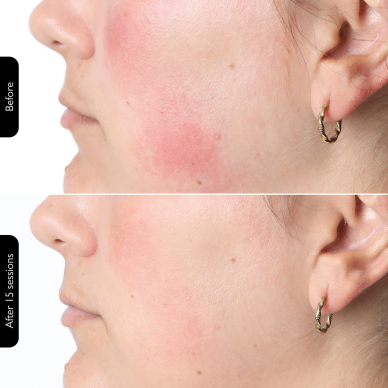 Омолаживающая светодиодная маска для лица Silk'n Face Mask 100 11